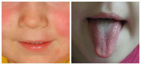 Бледный носогубный треугольник и высыпания на языке