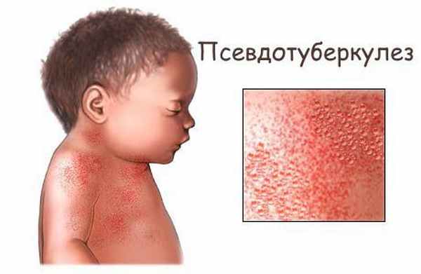 Псевдотуберкулёз