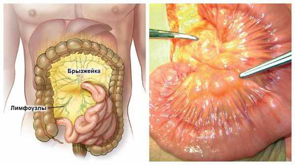 Лимфаденит брыжейки