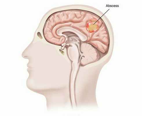 Абсцесс мозга