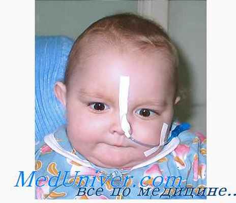 Психогенные припадки. Псевдоприпадки