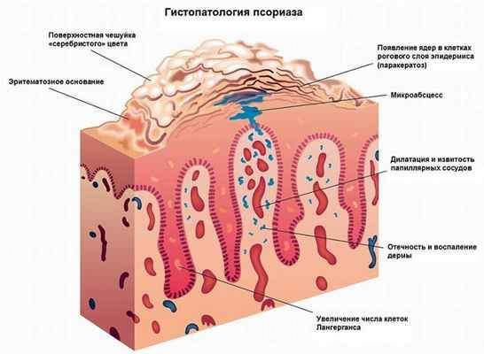 psoriaz-lechenie.jpg