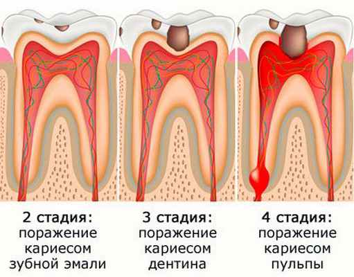 лечение пульпита