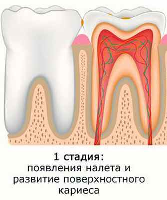лечение пульпита
