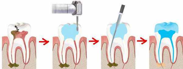 лечение пульпита