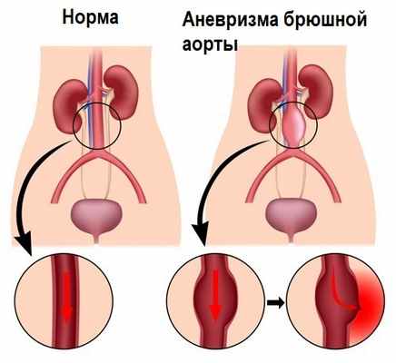 Аневризма брюшной аорты.jpg