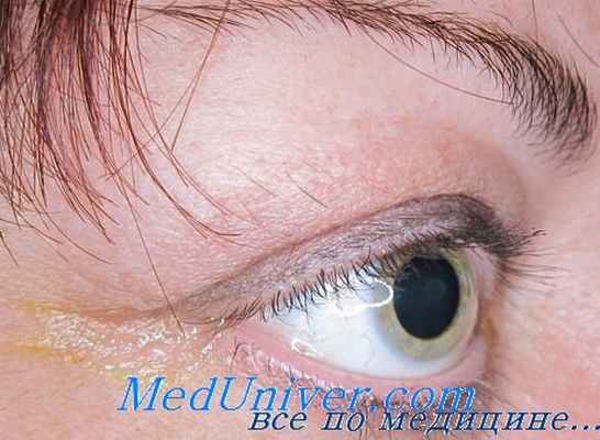 пульсирующий экзофтальм