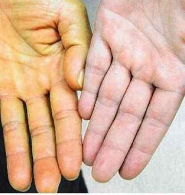 Фото Паренхиматозная желтуха