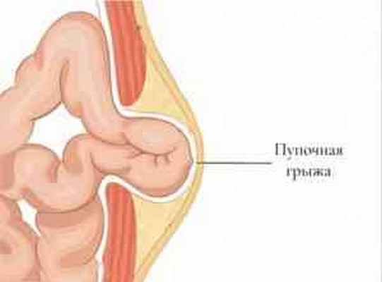 пупочная грыжа