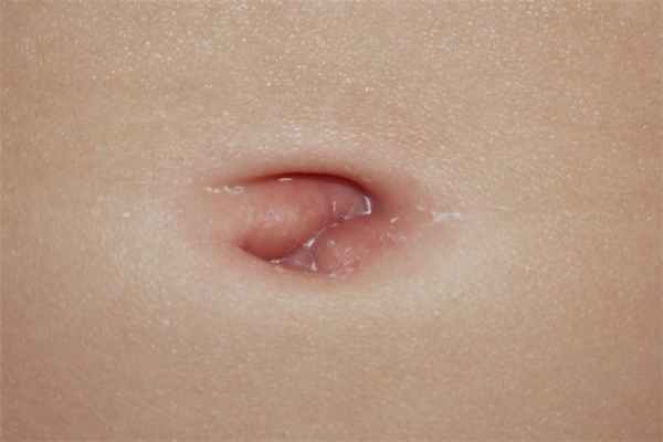 Фунгус пупка