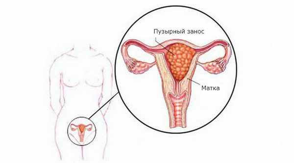 Пузырный занос