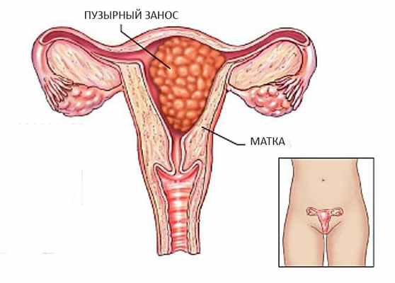 Пузырный занос.jpg