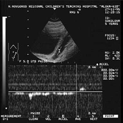ЛЕЧЕНИЕ ПУЗЫРНО-МОЧЕТОЧНИКОВОГО РЕФЛЮКСА У ДЕТЕЙ В ДОКБ