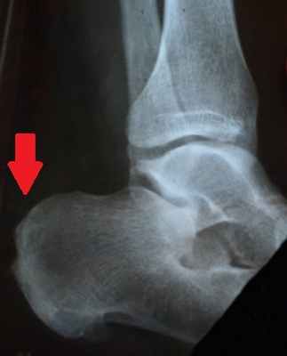 Стопа после операции шпоры на пятке