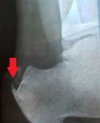 Пяточная шпора до операции