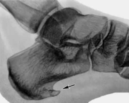 Пяточная шпора на снимке