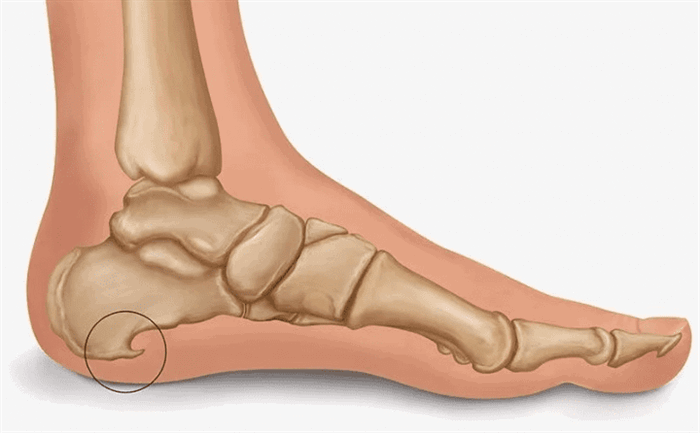 Пяточная шпора