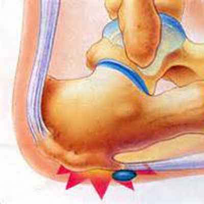 Пяточная шпора