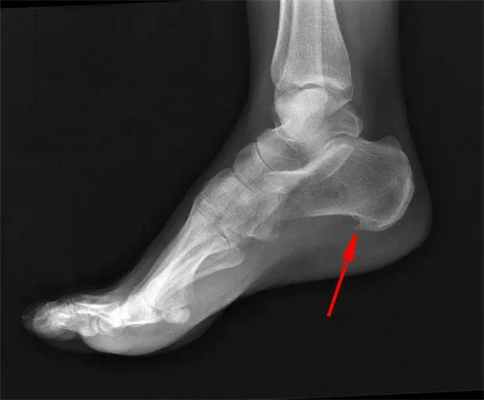 Причины пяточной шпоры