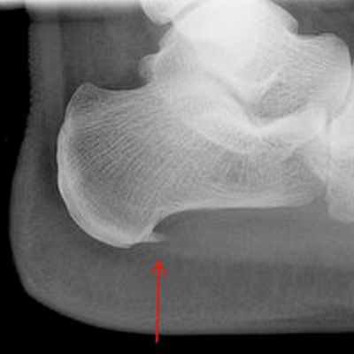 Диагностика пяточной шпоры