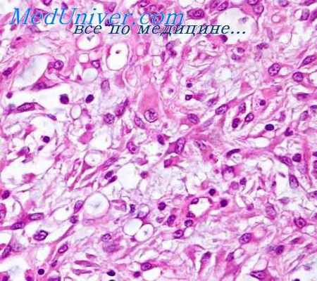 рабдомиосаркома