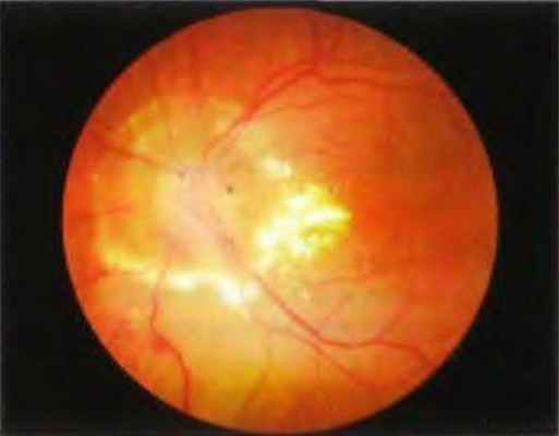 Радиационная оптическая нейропатия после дистанционной лучевой терапии