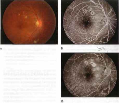 Радиационная ретинопатия после дистанционной лучевой терапии