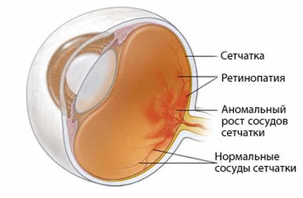 ретинопатия2.jpg