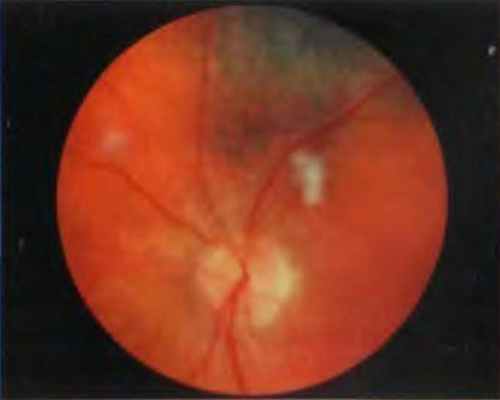 Радиационная ретинопатия после брахитерапии хориоидальной меланомы