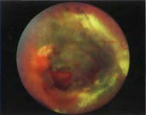 Радиационная ретинопатия, окружающая хориоидальную меланому, после брахитерапии