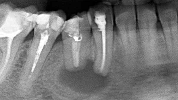 радикулярная киста