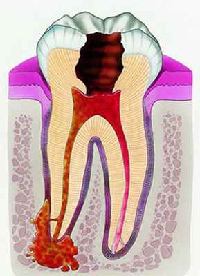Киста зуба - лечение