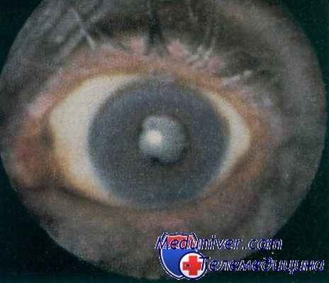 увеит при онхоцеркозе