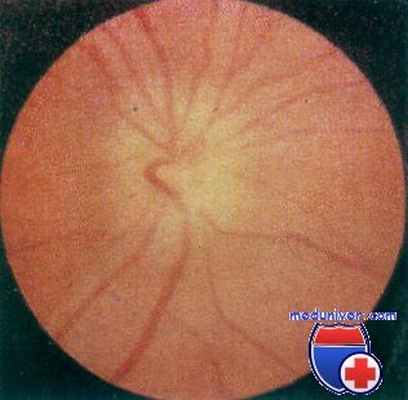 папиллит при онхоцеркозе