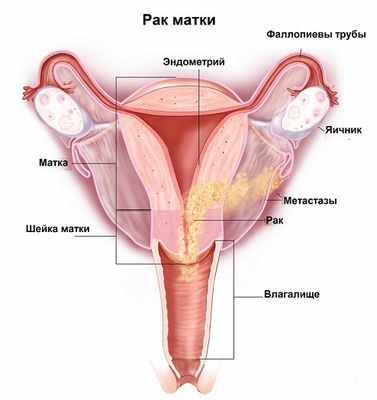 рак тела матки