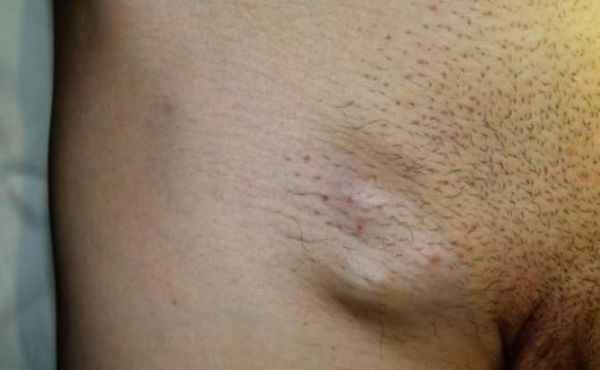 Увеличенные паховые узлы