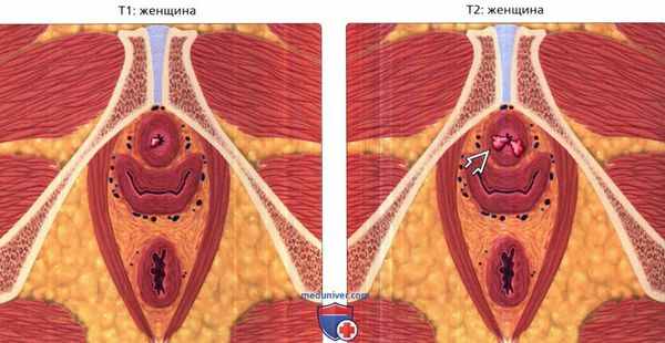 Стадии рака уретры