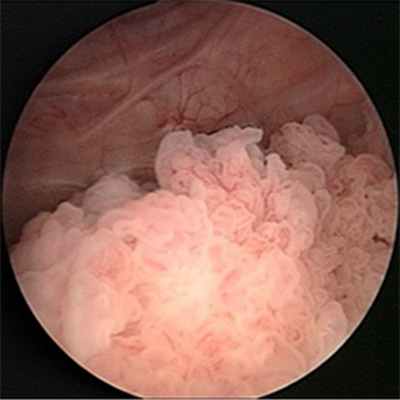 Стадии рака мочевого пузыря