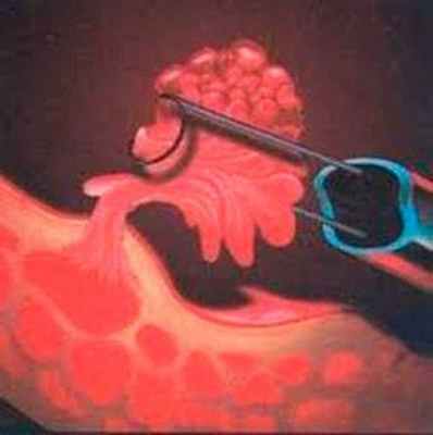 Лечение рака мочевого пузыря