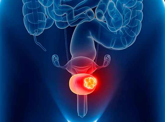 Рак мочевого пузыря