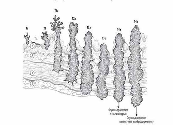 Рак мочевого пузыря онкология