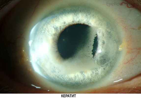 Кератит