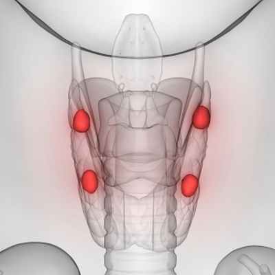 Рак паращитовидной железы