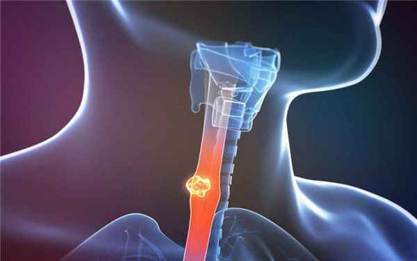 Рак пищевода