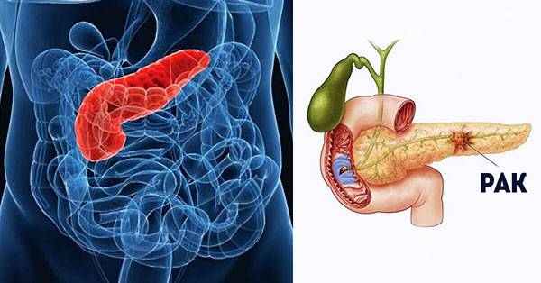 Рак поджелудочной железы