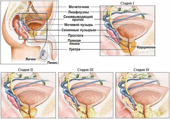 рак предстательной железы