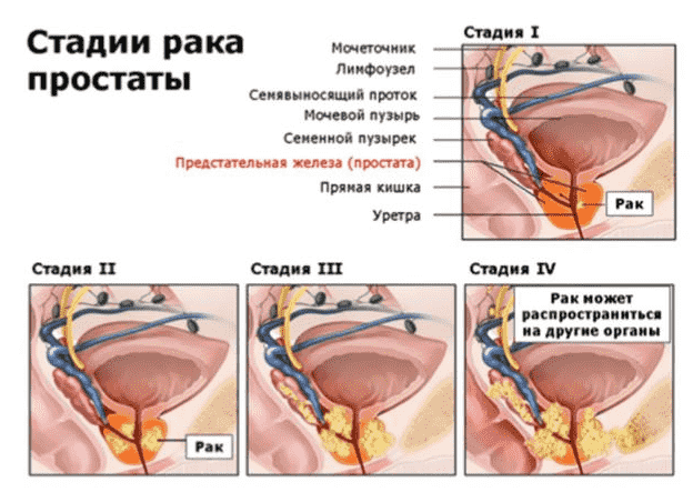 стадии рака простаты информация фото