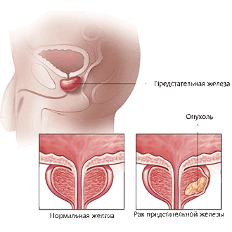 Рак предстательной железы