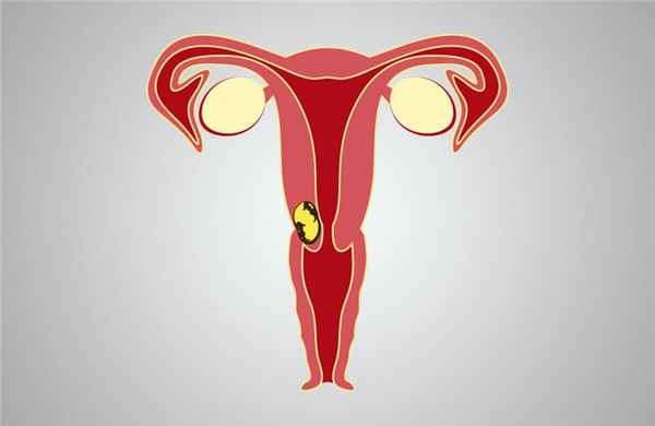 Рак влагалища