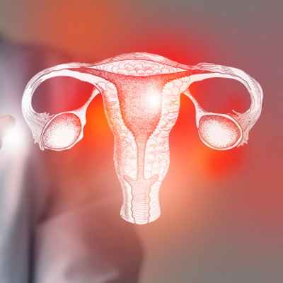 Рак влагалища